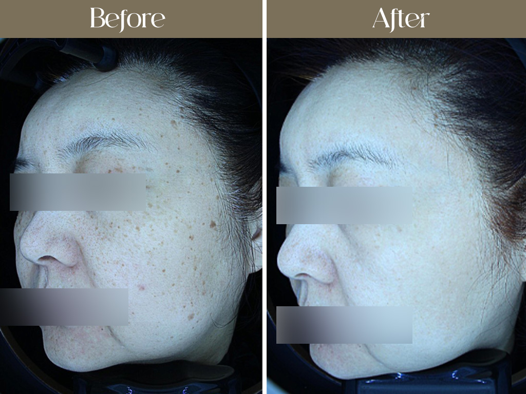 부산피부과 그대고운피부과 전후 사진