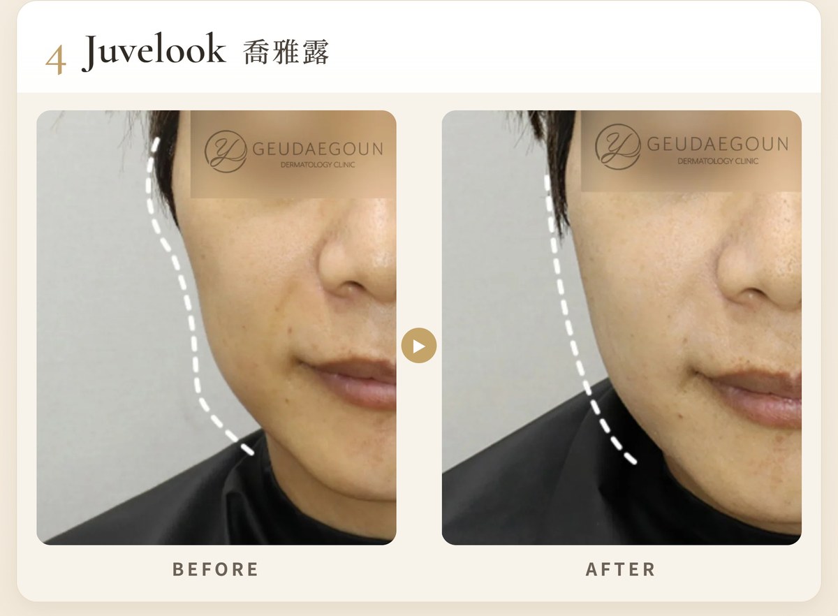 4. 喬雅露 Juvelook(Juvelook喬雅露)膠原增生