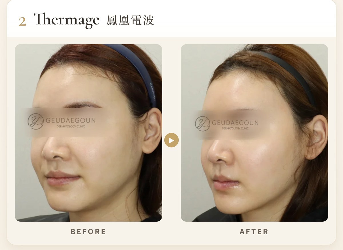2. 鳳凰電波 Thermage FLX(熱瑪吉・電波)