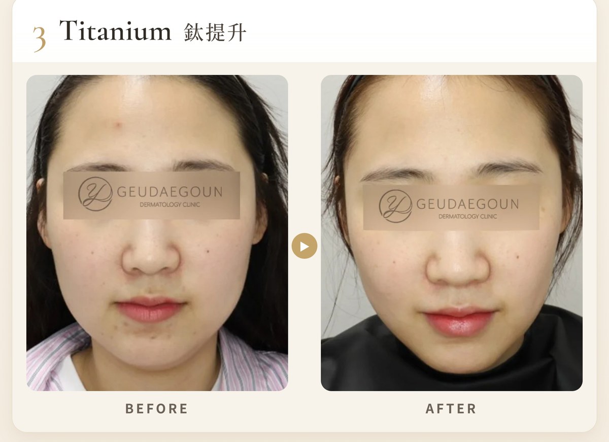 3. 鈦提升 Titanium Lifting(鈦金拉提)