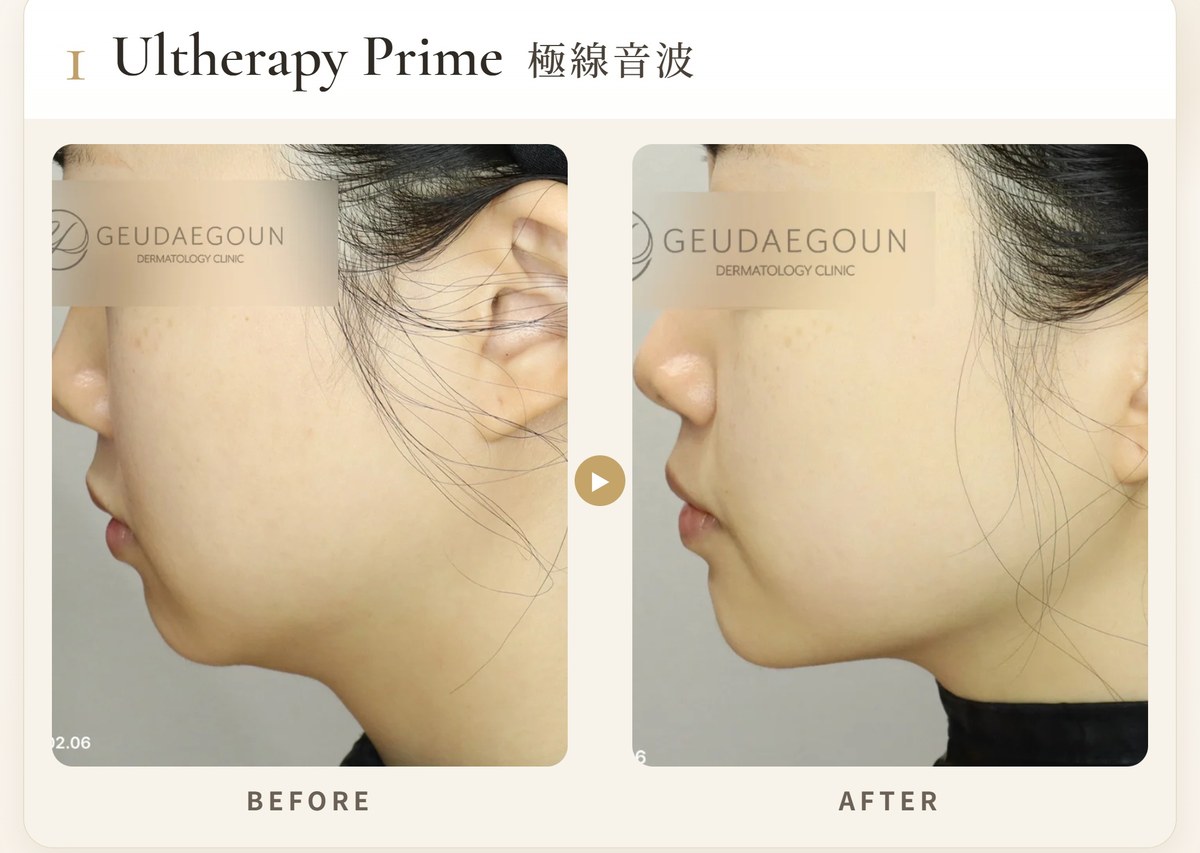 1. 美國音波 極透+ Ultherapy PRIME(極線音波)