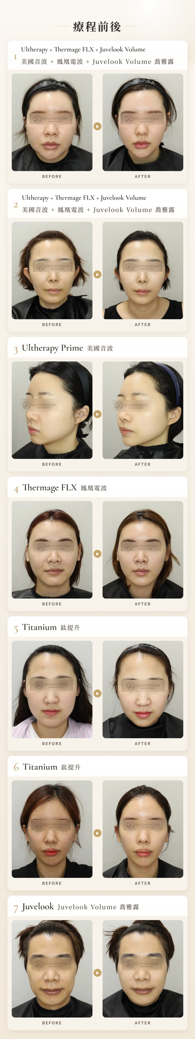 Ultherapy+Thermage FLX+Juvelook Volume 本院前後案例